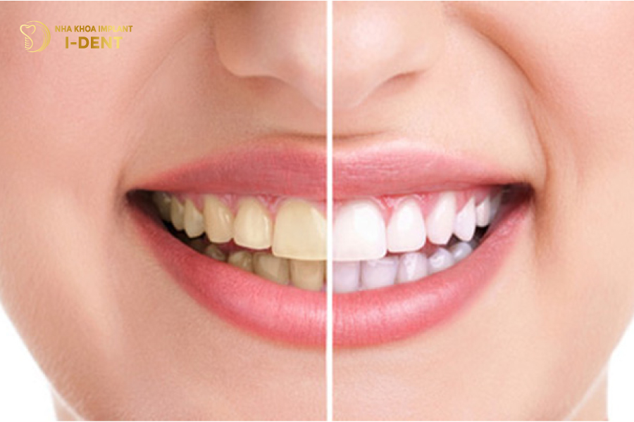 Người có răng ố vàng, xỉn màu là một trong những trường hợp phổ biến cần thực hiện tẩy răng