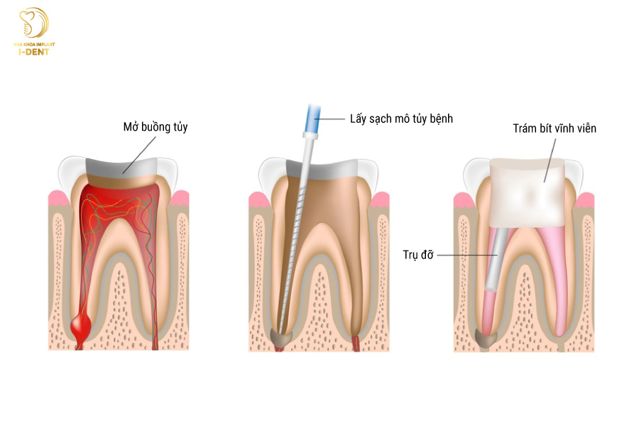 Trám răng có cần lấy tủy hay không?