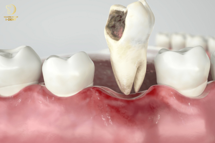 Răng sâu có nên trám không?