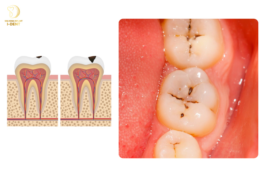 Trám răng được áp dụng khi răng có nhiều rãnh đen 