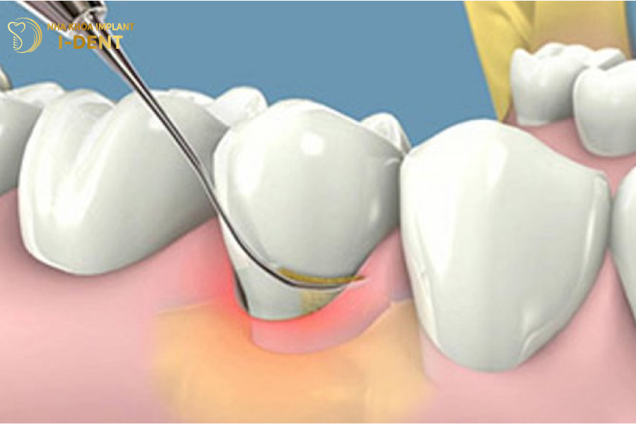 Cạo vôi răng giúp làm sạch răng miệng và kéo dài tuổi thọ trụ Implant