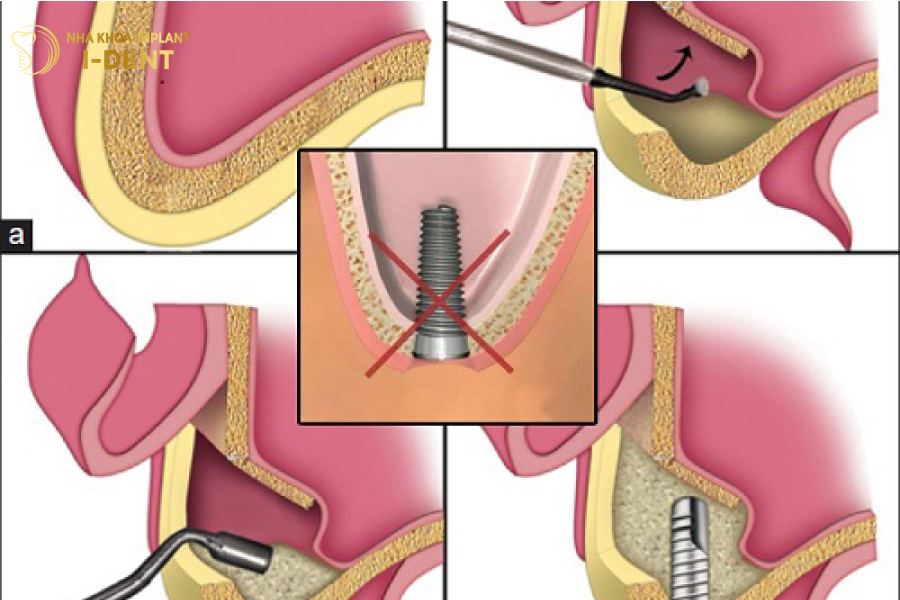 Nếu bệnh nhân ghép xương, nâng xoang sẽ kéo dài thời gian trồng răng