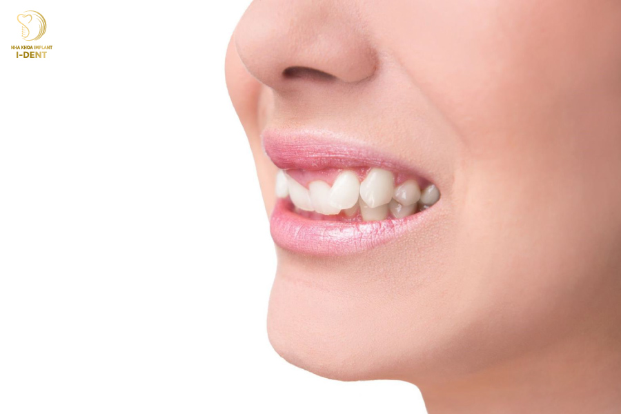 Răng bị khấp khểnh ảnh hưởng đến sức khỏe răng miệng