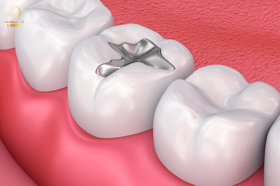 Trám răng giúp bảo vệ cấu trúc răng thật