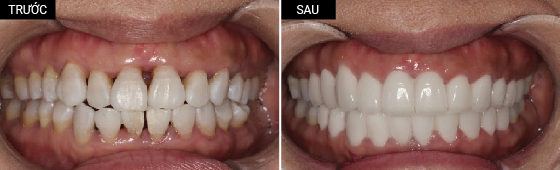 Khách hàng bọc răng sứ toàn hàm với màu răng om1