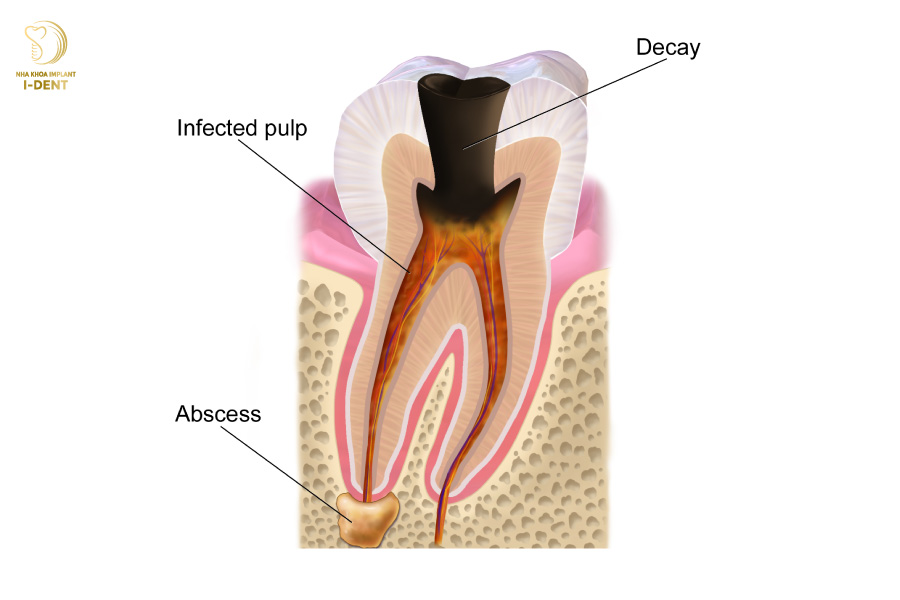 Dấu hiệu răng bị chết tủy là bị viêm tủy không phục hồi