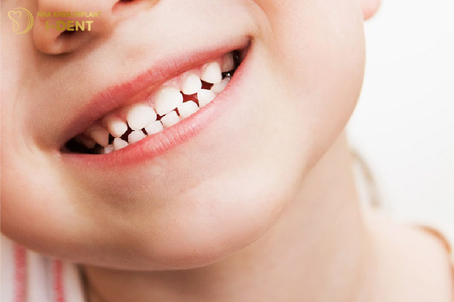 Bọc sứ cho trẻ có thể gây cản trở việc mọc răng
