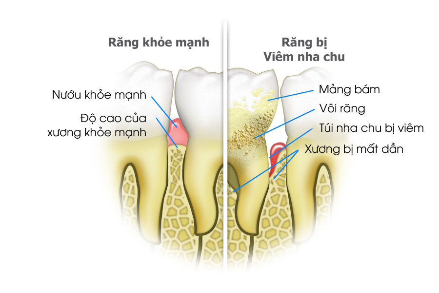 Dễ mắc các bệnh răng miệng khác