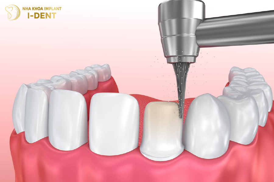 Cách Giảm Ê Buốt Sau Khi Mài Răng Hiệu Quả Tại Nhà