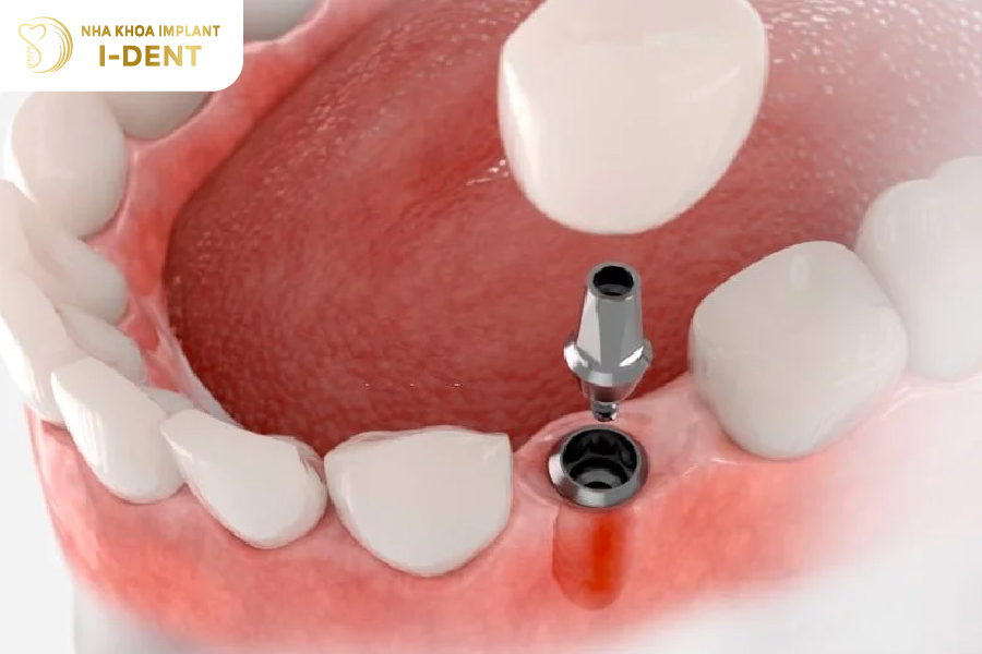 Cắm implant cho răng bị gãy đôi theo chiều dọc