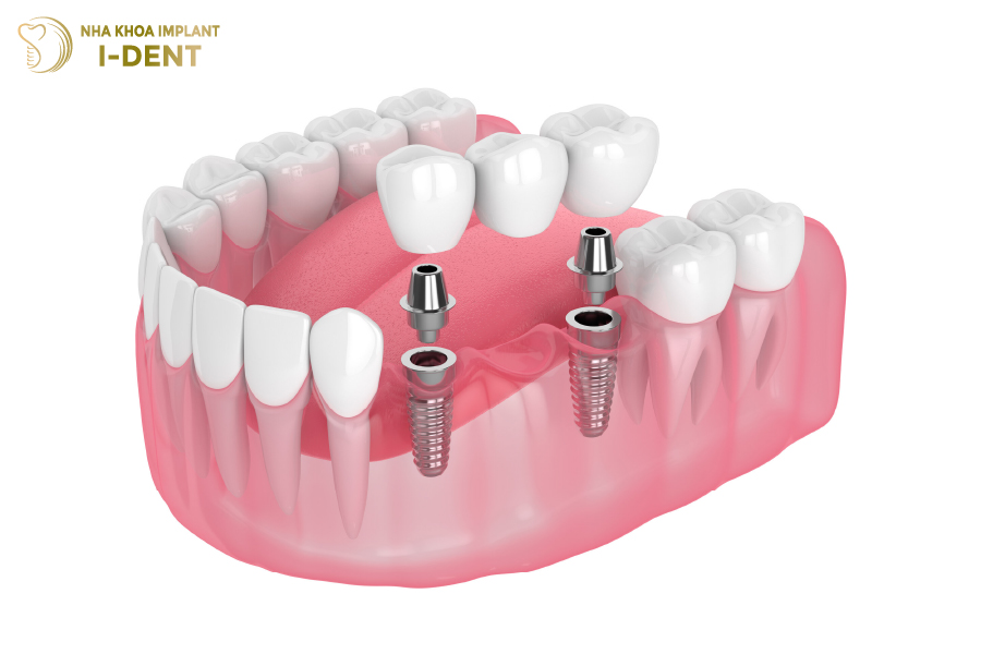 Cầu răng có Implant hỗ trợ