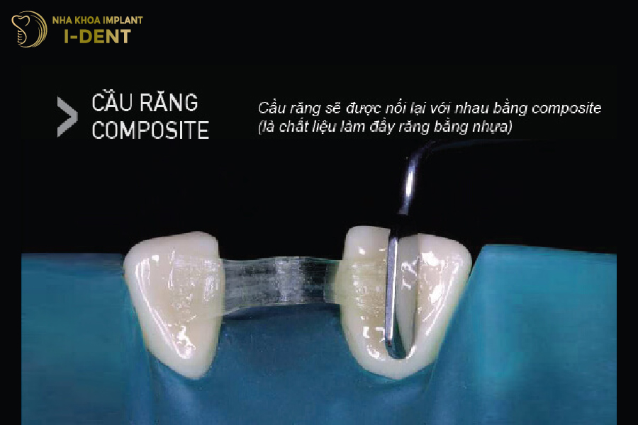 Cầu răng Composite