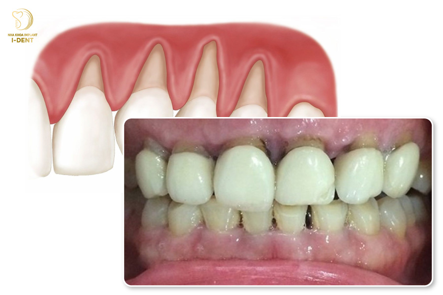 Cầu răng sứ gây tụt nướu và dẫn đến nhiều bệnh lý răng miệng