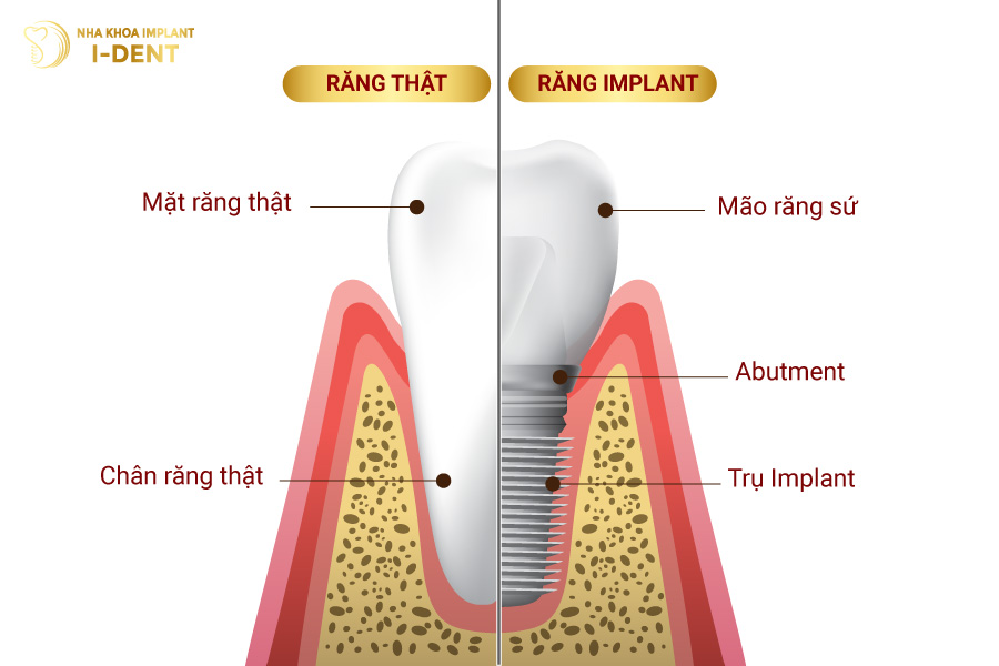 Cấu trúc của răng Implant và răng thật