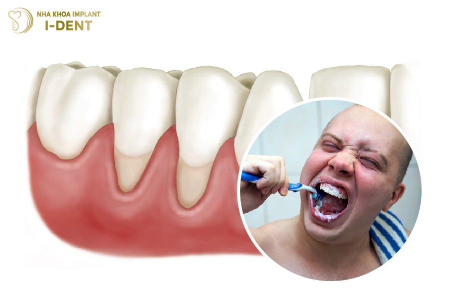 Chải răng với lực mạnh gây tổn thương và làm tụt nướu răng sứ