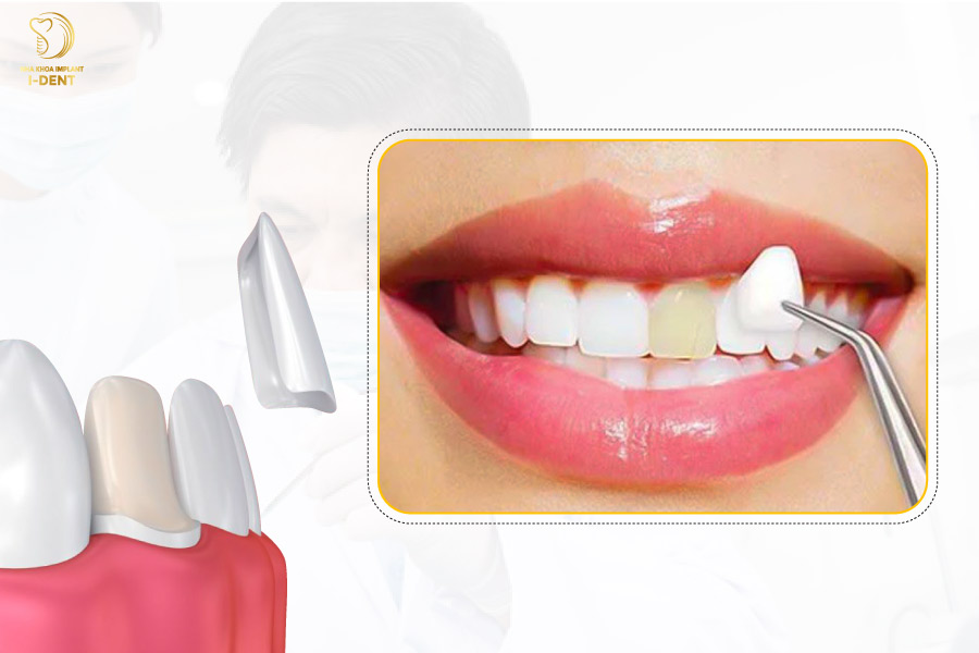 Có nên dán răng sứ veneer không? nó có bền không?