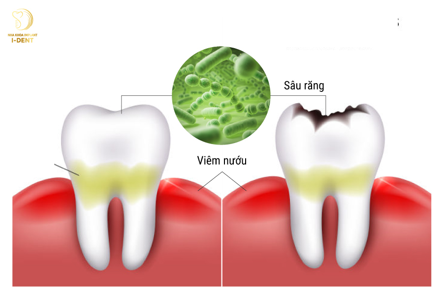 Răng bị viêm tủy do vi khuẩn gây hại tấn công hoặc bị nhiễm độc