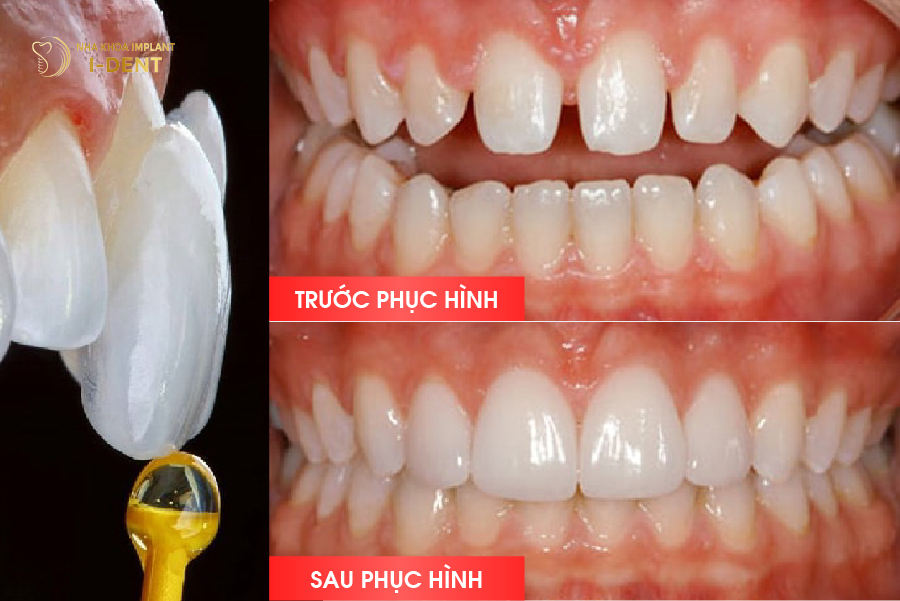 Hình ảnh trước và sau khi dán sứ Veneer ( trường hợp răng thưa ở mức độ nhẹ )