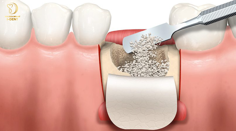 Cấy ghép màng xương không phải là kỹ thuật bắt buộc khi trồng răng Implant 