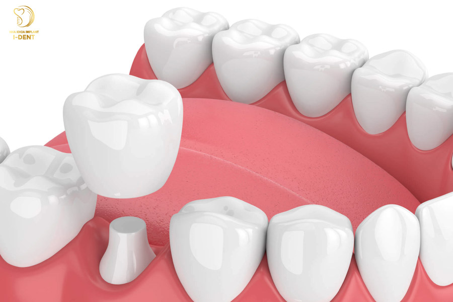 Răng sứ tương xứng với răng thật về hình dáng và kích thước