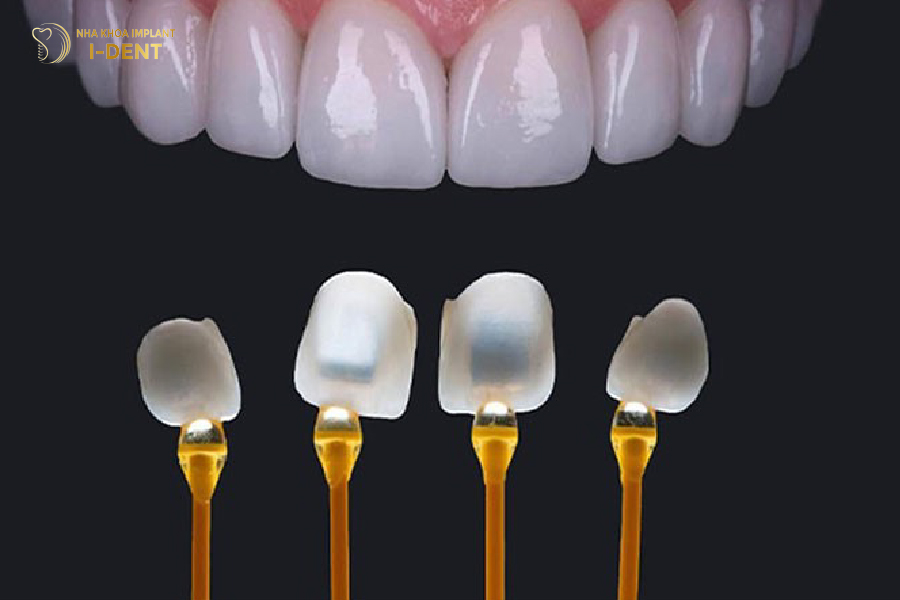 Kỹ thuật dán sứ không mài răng
