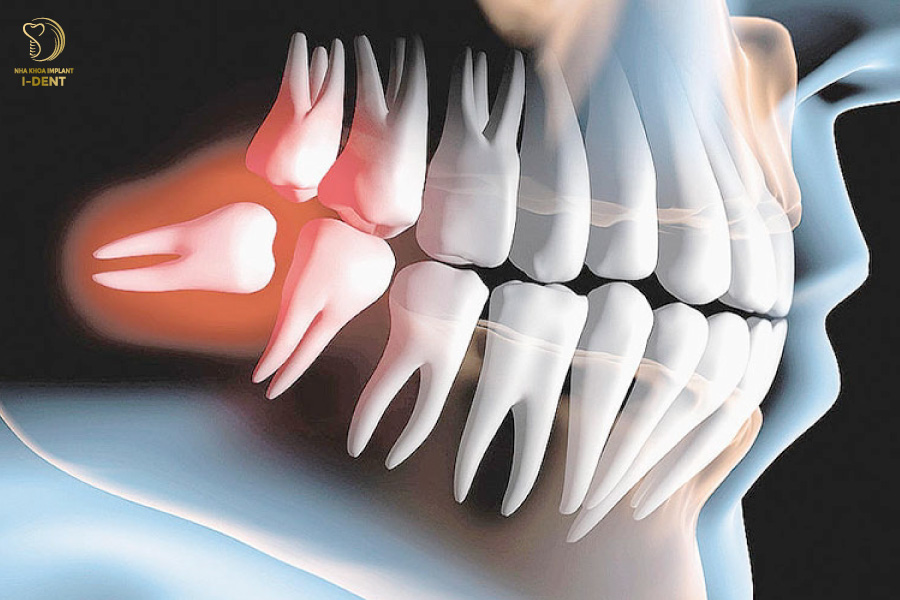 7 điều cần biết khi mọc răng khôn – Nha Khoa I-Dent