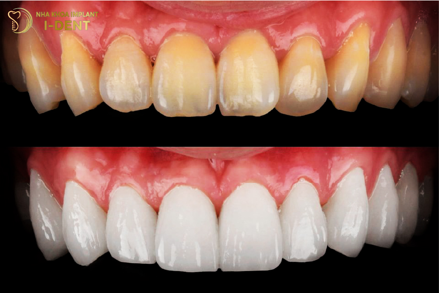Khi răng bị ố vàng, xỉn màu mức độ nhẹ nên dán răng sứ veneer