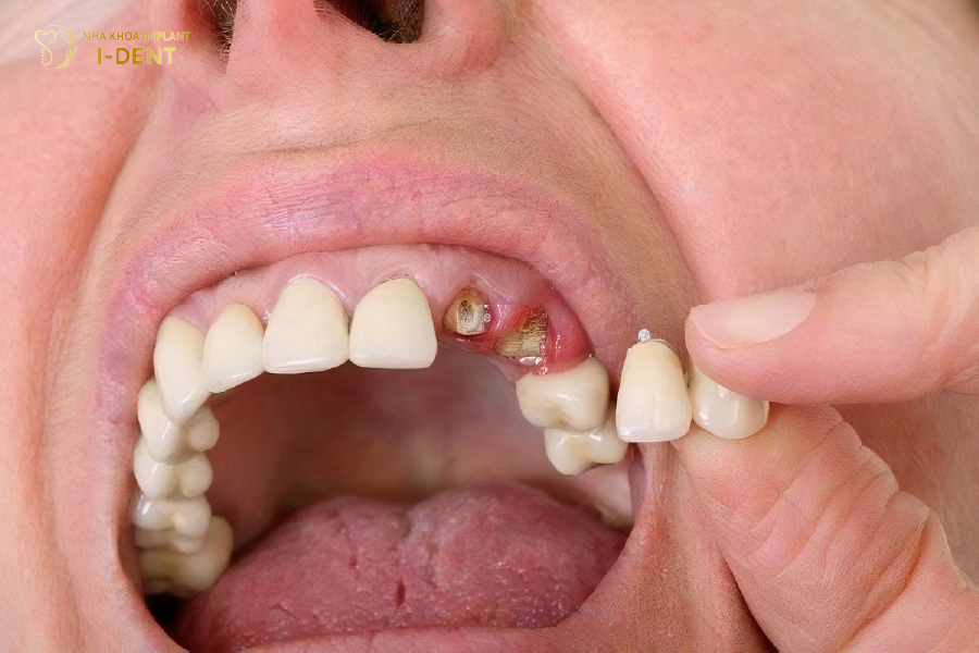 Những trường hợp răng chỉ còn lại chân răng
