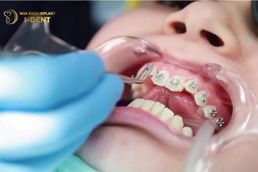 Niềng răng sau khi trồng Implant là điều có thể thực hiện