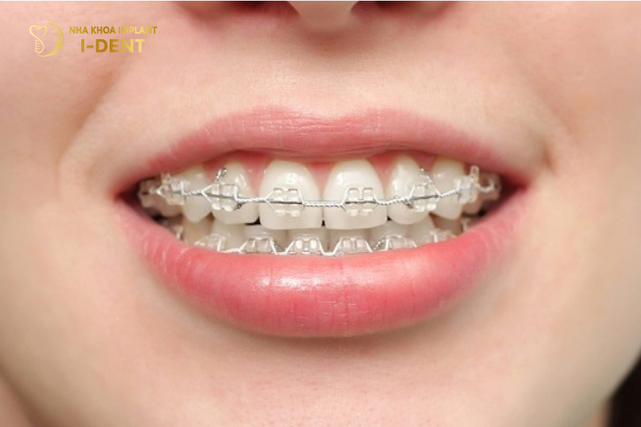 Hình ảnh quy trình niềng răng tại nha khoa I-DENT