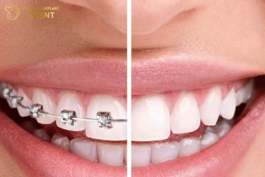 Niềng răng và bọc sứ giúp cải thiện thẩm mỹ cho răng hiệu quả