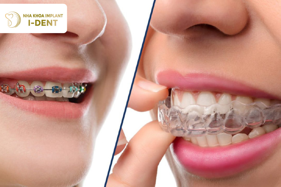 Niềng răng và bọc sứ sẽ phù hợp cho từng tình trạng răng khác nhau