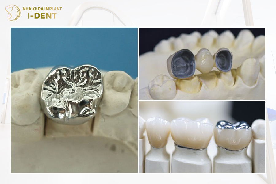 Phần sườn răng sứ kim loại chế tác từ các hợp kim cứng chắc