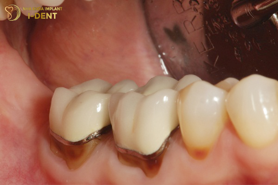 Phần tiếp giáp giữa răng sứ và nướu lộ rõ khe hở