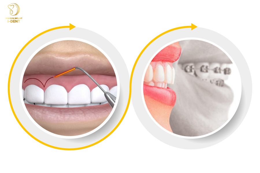 Phẫu thuật mài gồ xương ổ răng kết hợp với niềng răng