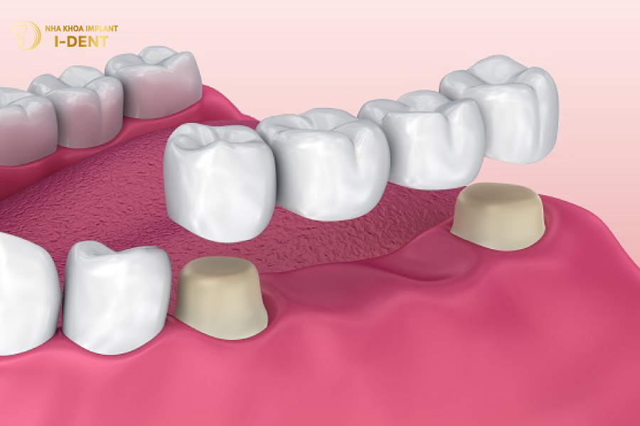 Phục hình 4 răng bằng phương pháp làm cầu răng sứ