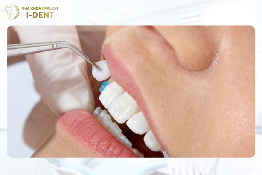 Quy trình tráng men răng khá đơn giản và không phải chăm sóc quá kỹ sau khi thực hiện