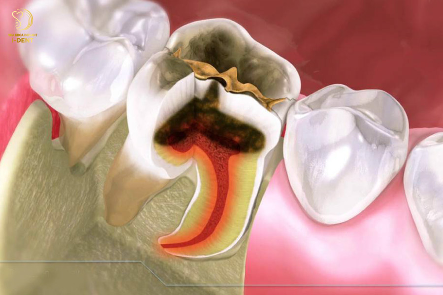 Răng cần được điều trị tủy khi bị viêm nhiễm và không còn khả năng phục hồi