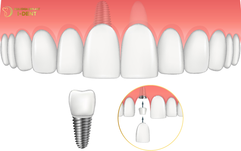Cắm Implant răng cửa đảm bảo an toàn cho sức khỏe