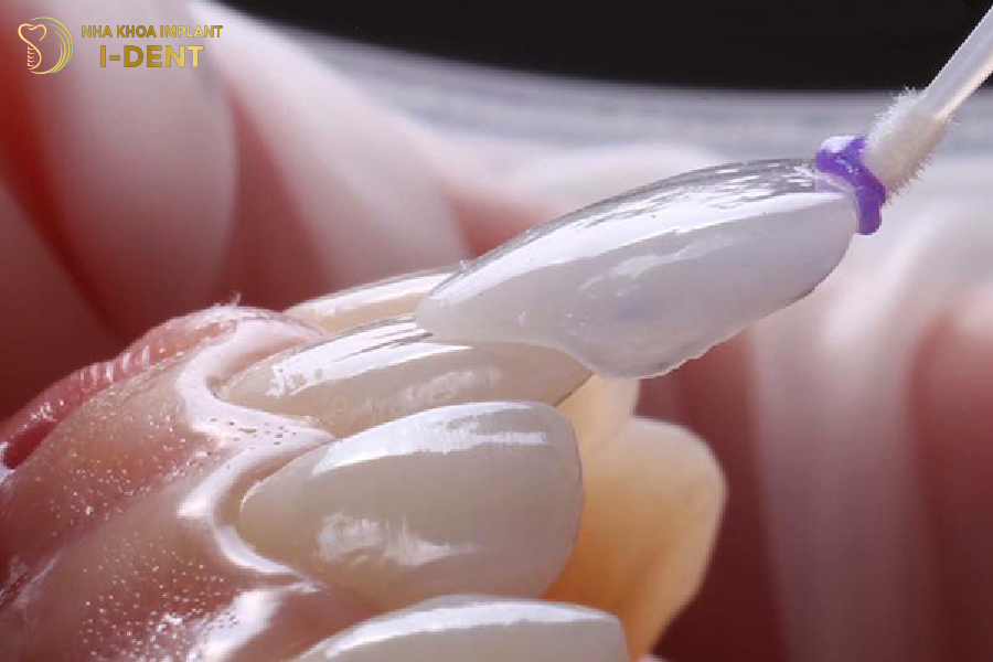 Răng gốc vẫn chắc khỏe sau khi dán sứ, do cấu trúc tự nhiên không bị xâm lấn