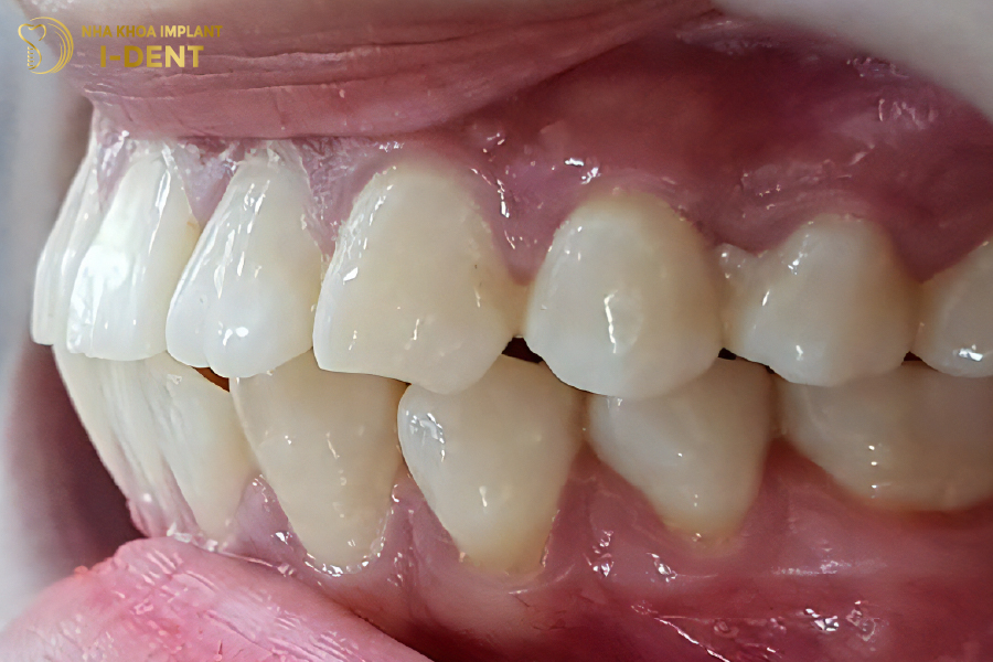 Răng hô là khuyết điểm răng miệng thường gặp