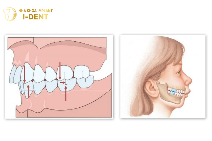 Răng hô ở mức độ nhẹ có thể điều trị bằng bọc sứ