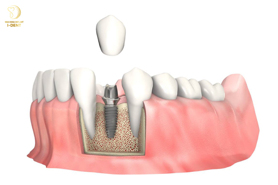 Răng Implant cấu tạo giống như răng thật
