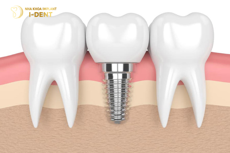 Phục hình răng sứ trên Implant