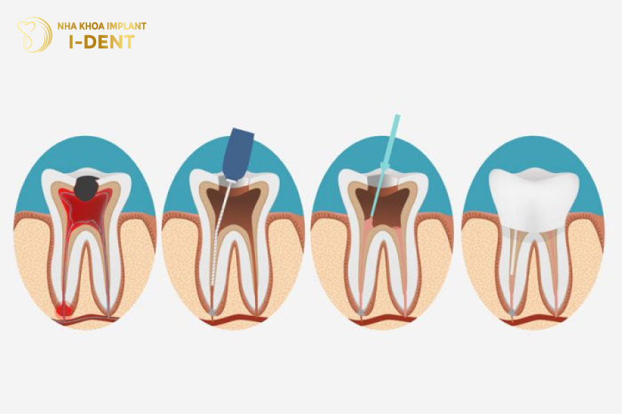 Răng lấy tủy được bọc sứ có thể tồn tại 10 - 15 năm, thậm chí là vĩnh viễn.