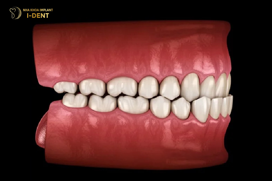Răng móm là dạng khớp cắn ngược, ảnh hưởng đến thẩm mỹ lẫn ăn nhai