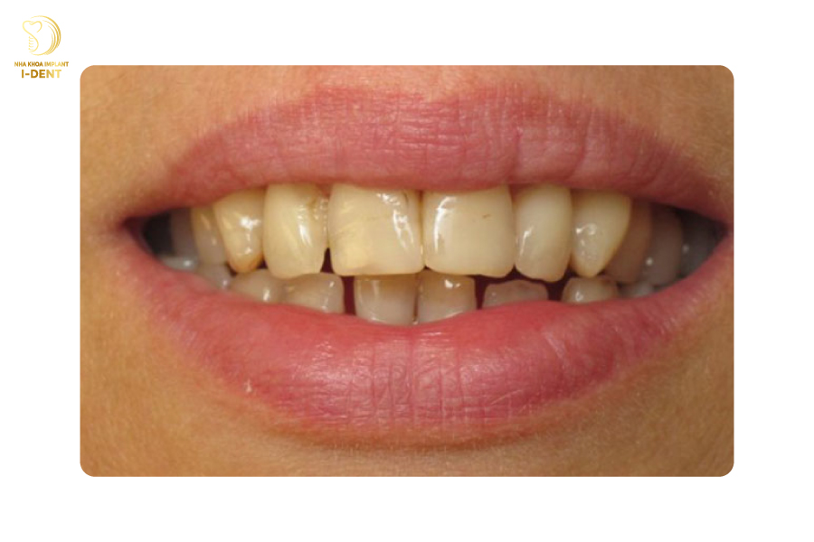 Mặt dán sứ Veneer Emax khắc phục tình trạng răng ố vàng, khấp khểnh.