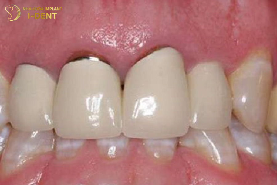 Răng sứ kim loại dễ bị biến chất và gây mùi hôi miệng