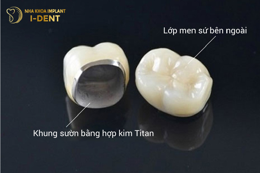 Cấu tạo của răng sứ Titan có chứa thành phần kim loại