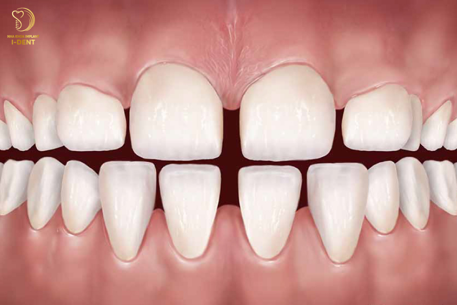 Răng thưa gây khó khăn trong quá trình ăn nhai